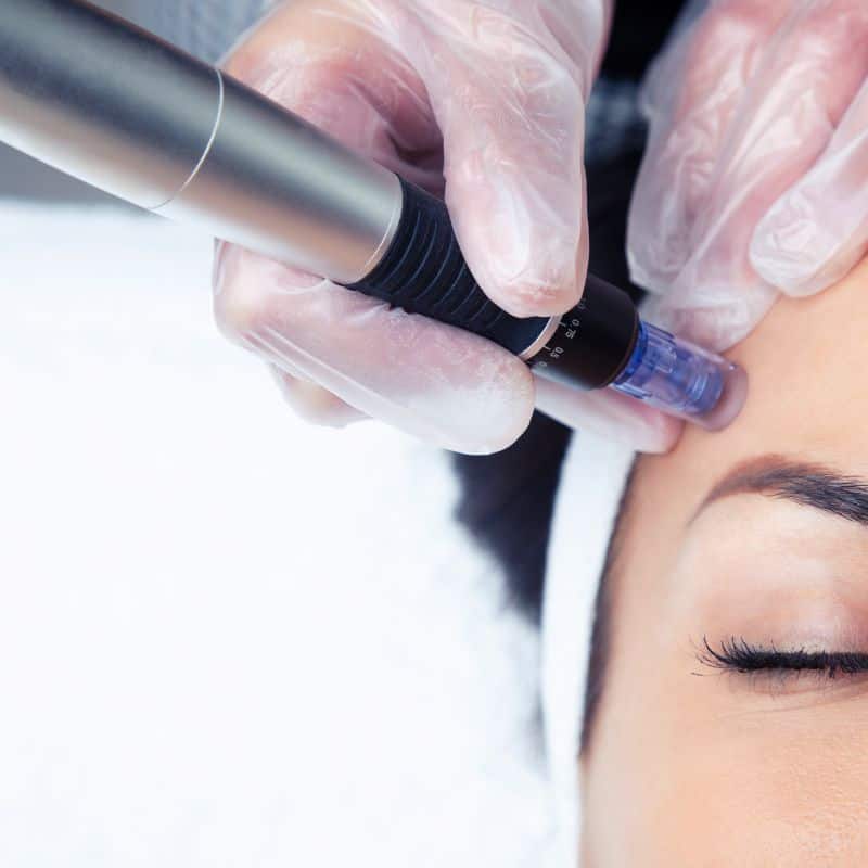 Morpheus8 treatment Springfield from Lipo Sculpt - Book in today!
