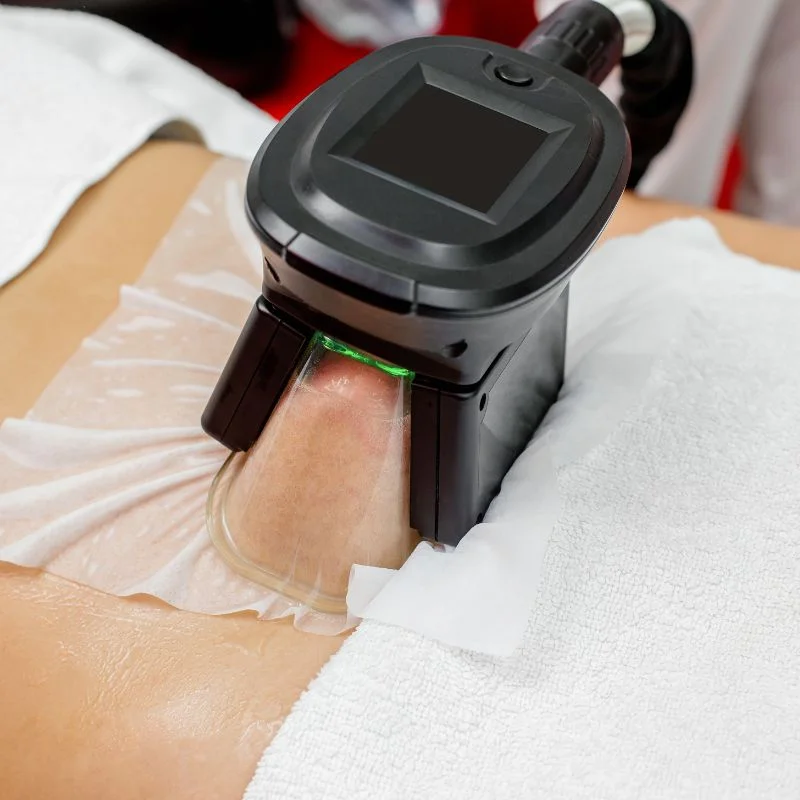 Fat Freezing treatment Springfield